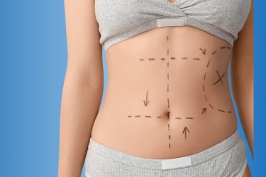 Abdominoplasty surgery in mohali, best cosmetic surgeon for labdominoplasty surgery, best centre for abdominoplasty in Mohali Punjab, Cost of Abdominoplasty in Punjab, India