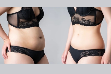 Abdominoplasty surgery in mohali, best cosmetic surgeon for labdominoplasty surgery, best centre for abdominoplasty in Mohali Punjab, Cost of Abdominoplasty in Punjab, India 