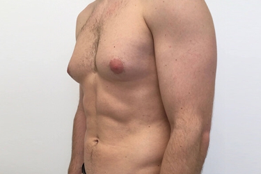 Gynecomastia Surgery in Mohali, Surgery for Male Breast in Mohali, Best Centre for Gynecomastia, CLAGS Best Centre for Gynecomastia Surgery in Punjab, India, Cost of Gynecomastia Surgery in Punjab