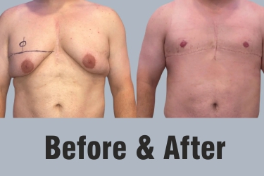 Gynecomastia Surgery in Mohali, Surgery for Male Breast in Mohali, Best Centre for Gynecomastia, CLAGS Best Centre for Gynecomastia Surgery in Punjab, India, Cost of Gynecomastia Surgery in Punjab