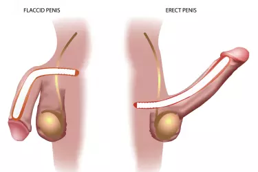 best hospital for penile implant surgery in mohali, ed treatment in mohali, best sexologist in mohali, penis surgery in mohali, surgery for increasing penis length in mohali, Penile Implant Surgery for Errectie Dysfunction in Mohali, Cost of Penile Implant Surgery in Punjab, India